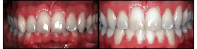 Sandy Center Family & Cosmetic Dentistry veneers result — Sandy, UT