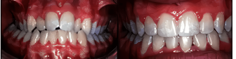 Sandy Center Family & Cosmetic Dentistry veneers result — Sandy, UT