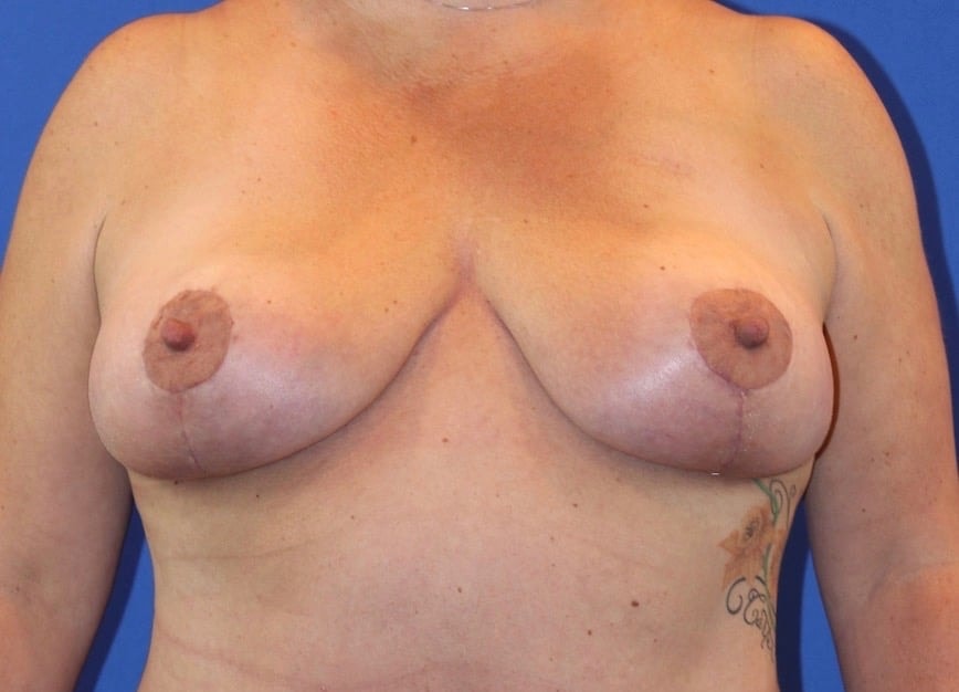 A result from Farris Plastic Surgery