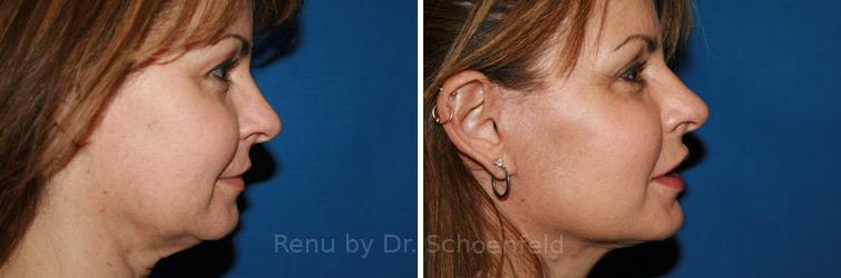 A result from RENU by Dr. Philip S Schoenfeld (Plastic Surgeon)