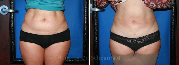 A result from RENU by Dr. Philip S Schoenfeld (Plastic Surgeon)