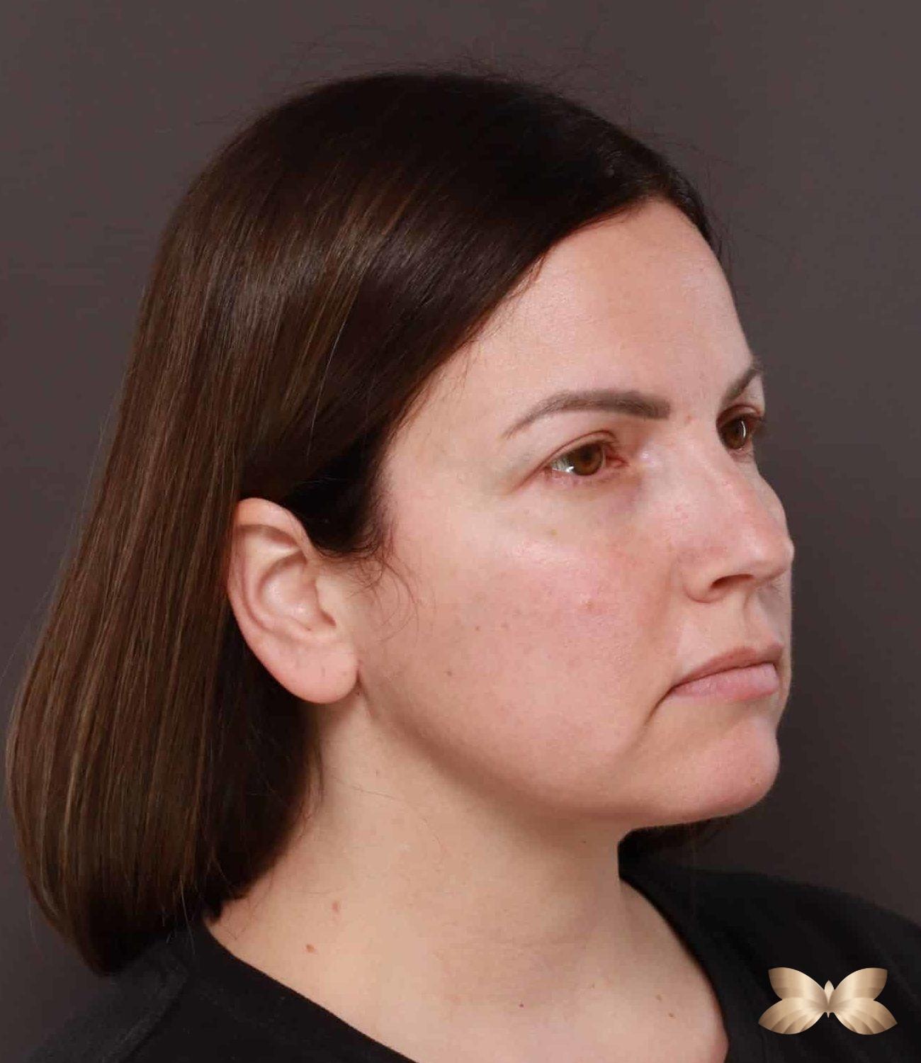 A result from Utah Facial Plastics & UFP Hair Restoration