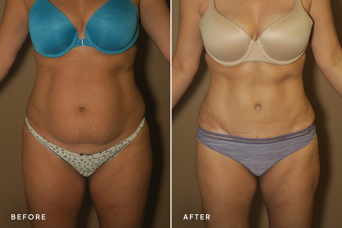 A result from New Horizons Center for Cosmetic Surgery (Gregory A. Turowski, MD)