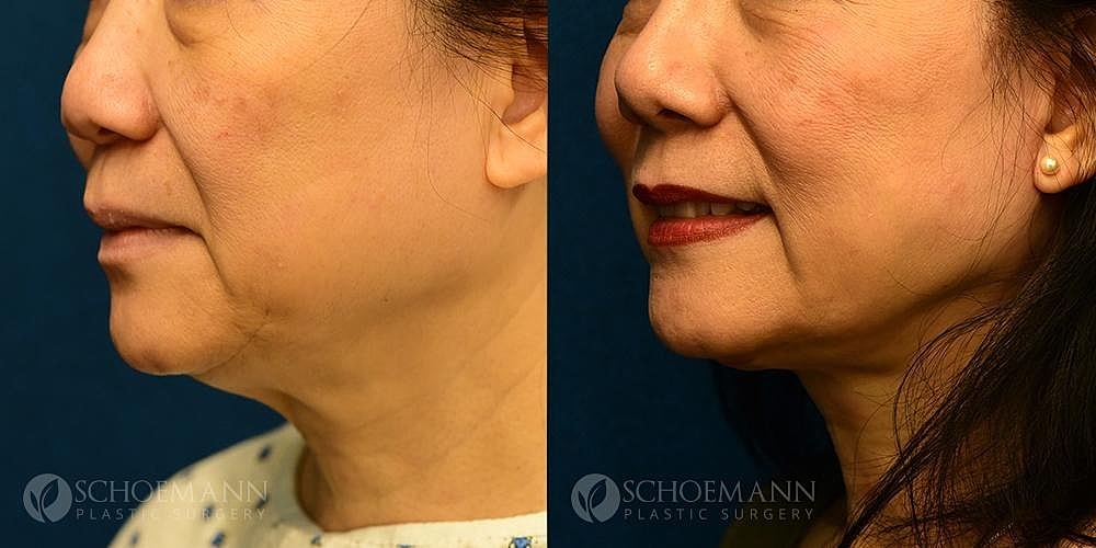 A result from Dermacare Encinitas at Schoemann Plastic Surgery