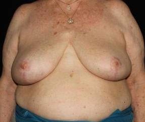 A result from Cirillo Center for Plastic Surgery