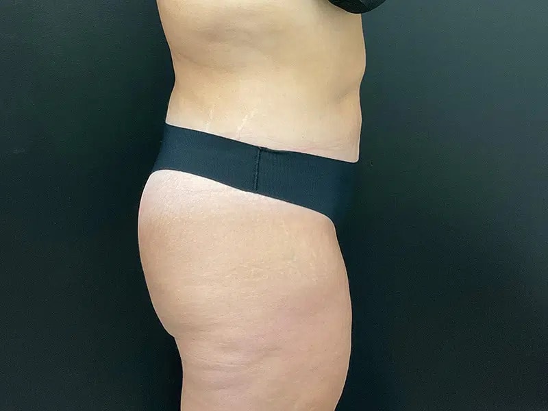 A result from Après Plastic Surgery