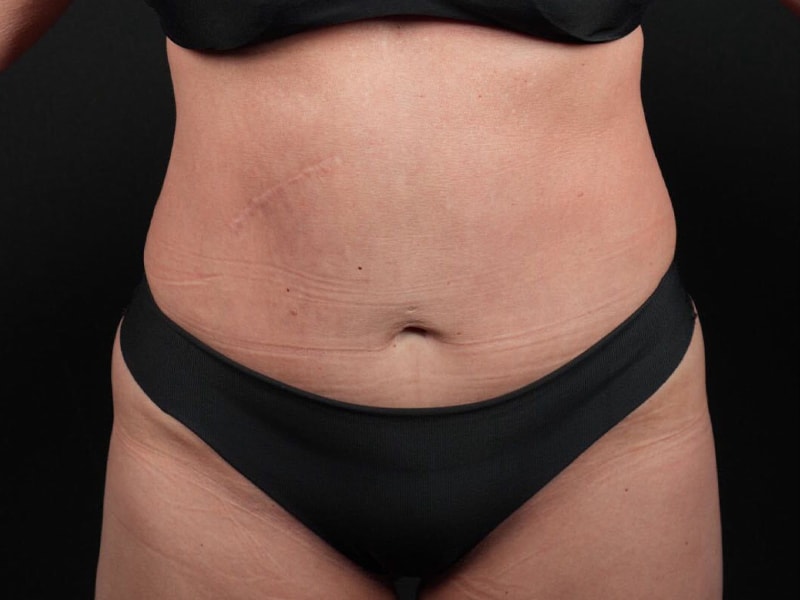 A result from Après Plastic Surgery