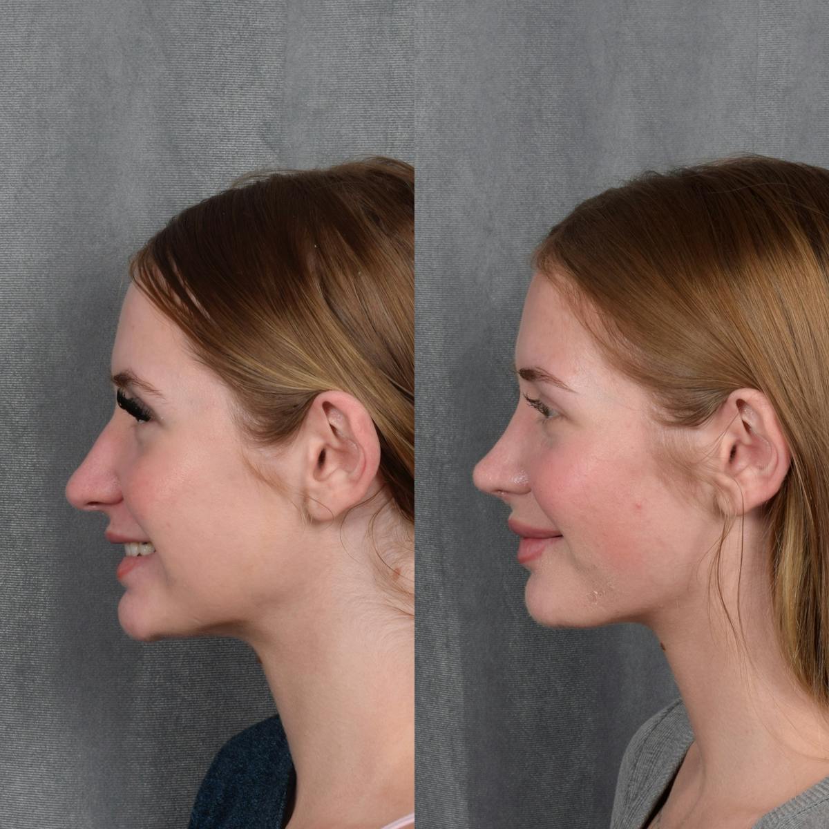 Rhinoplasty result at Vegas Facial Plastics