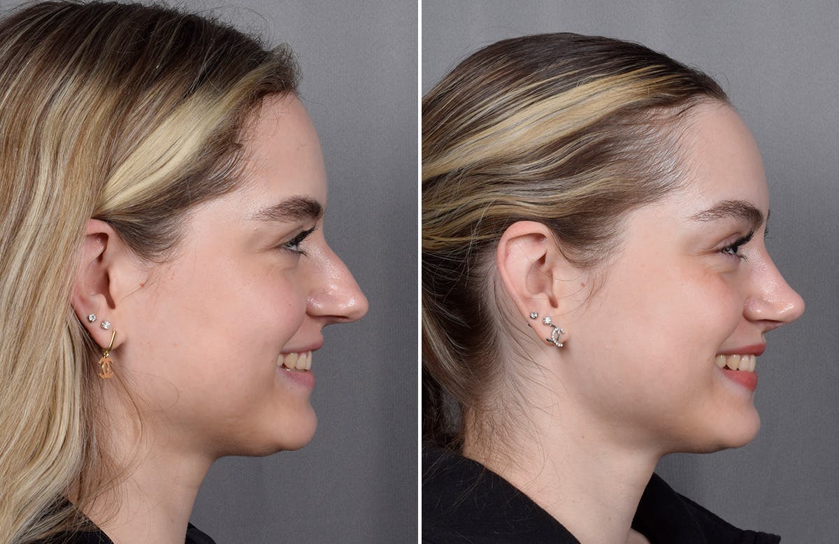 Rhinoplasty result at Vegas Facial Plastics