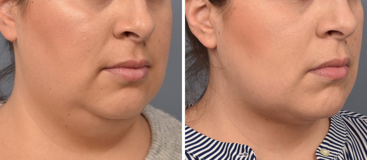 Neck Lift result at Vegas Facial Plastics