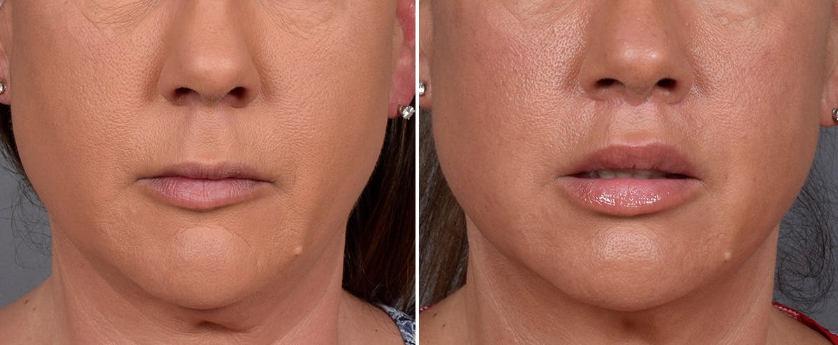 Lip Lift result at Vegas Facial Plastics
