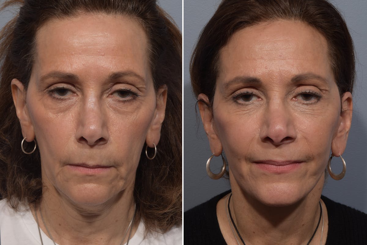 Facelift result at Vegas Facial Plastics