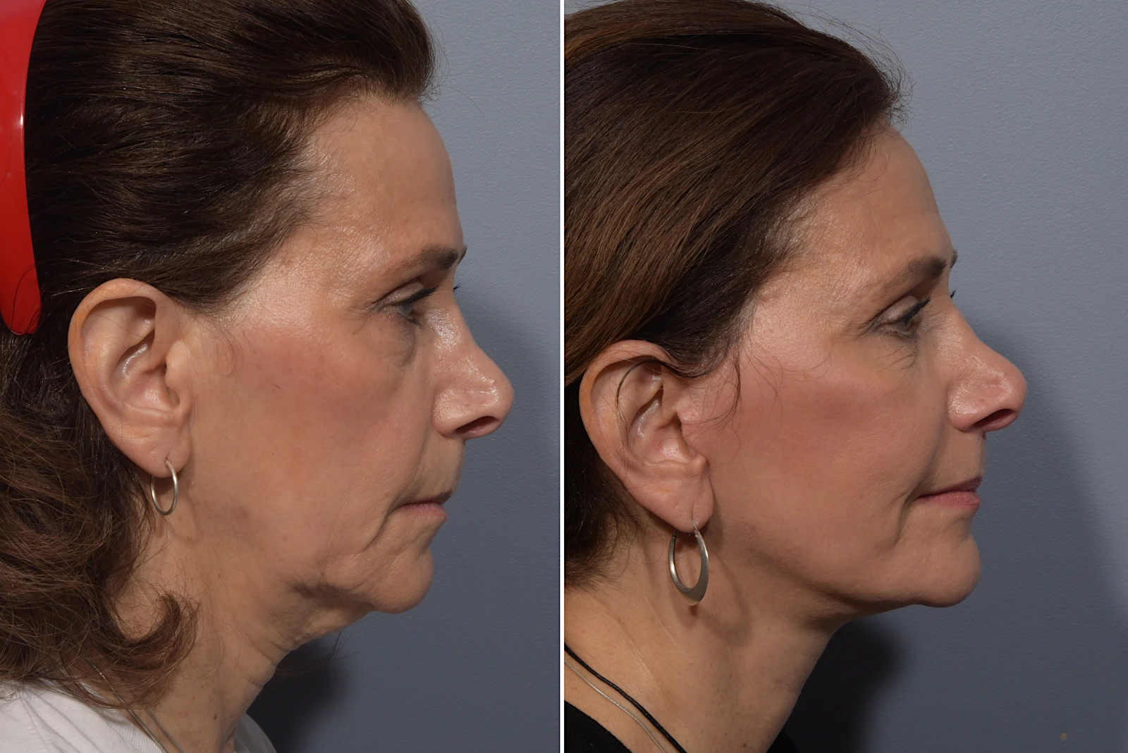 A result from Vegas Facial Plastics