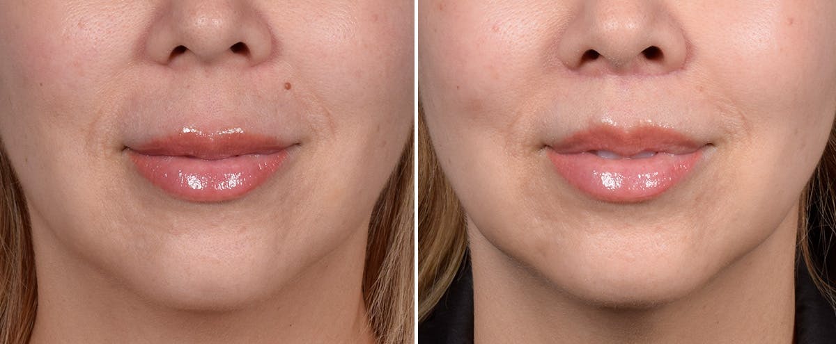 Lip Lift result at Vegas Facial Plastics