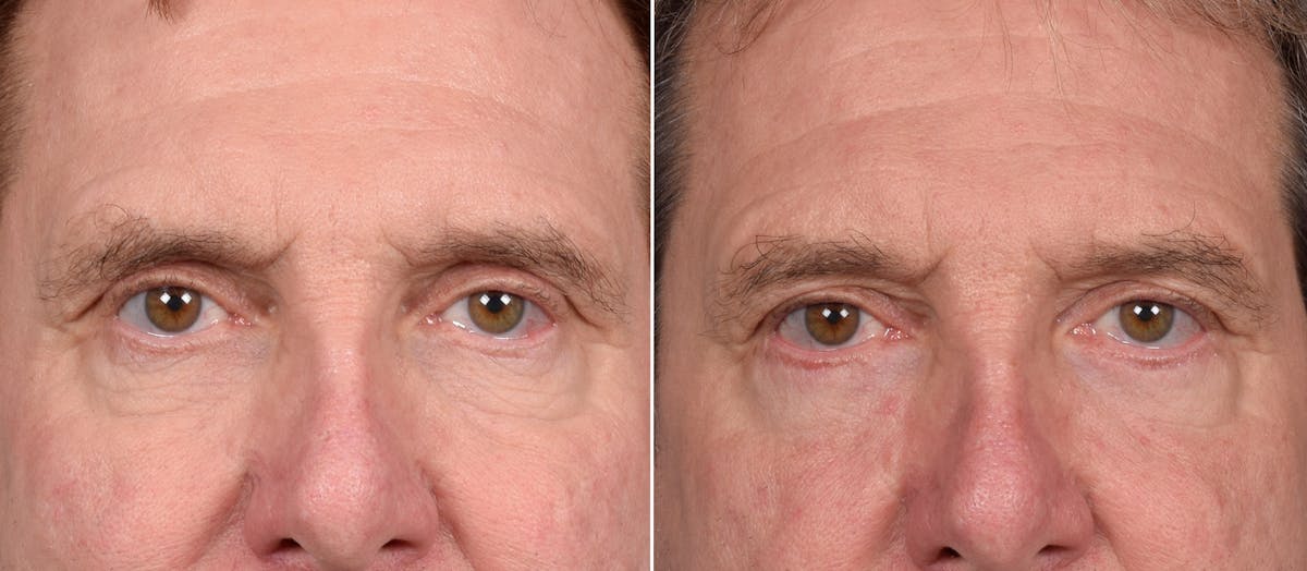 Blepharoplasty result at Vegas Facial Plastics