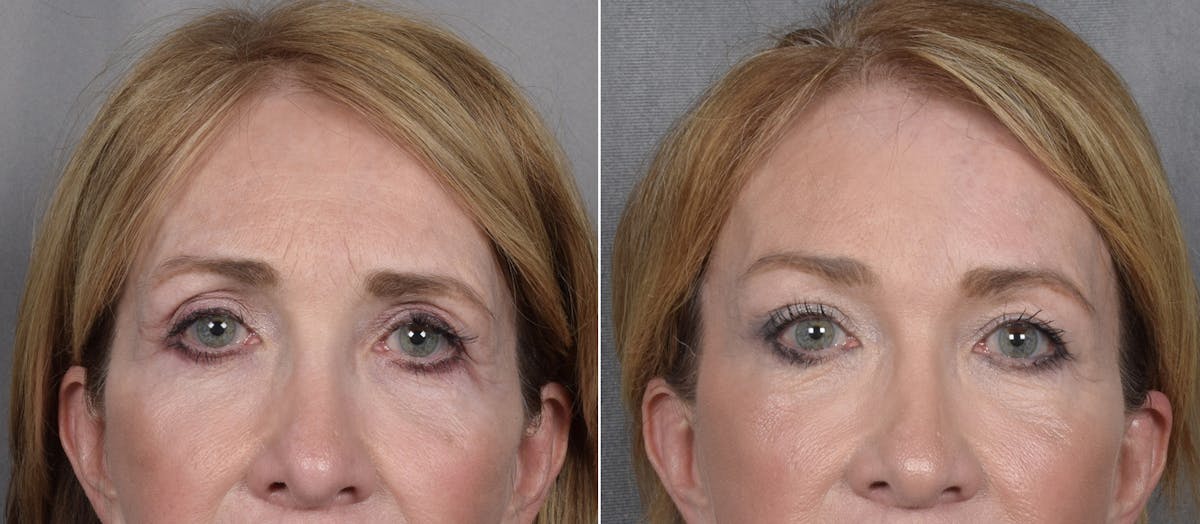 Brow Lift result at Vegas Facial Plastics