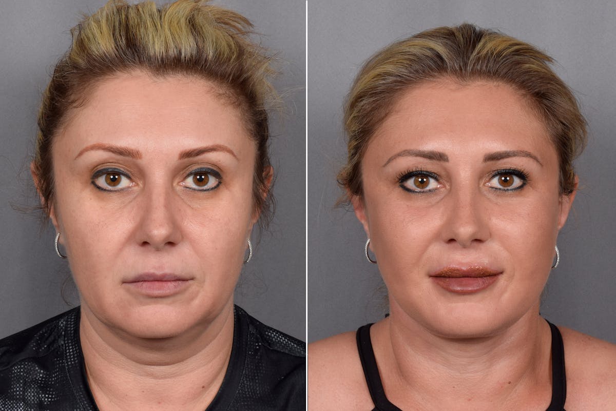 Facelift result at Vegas Facial Plastics