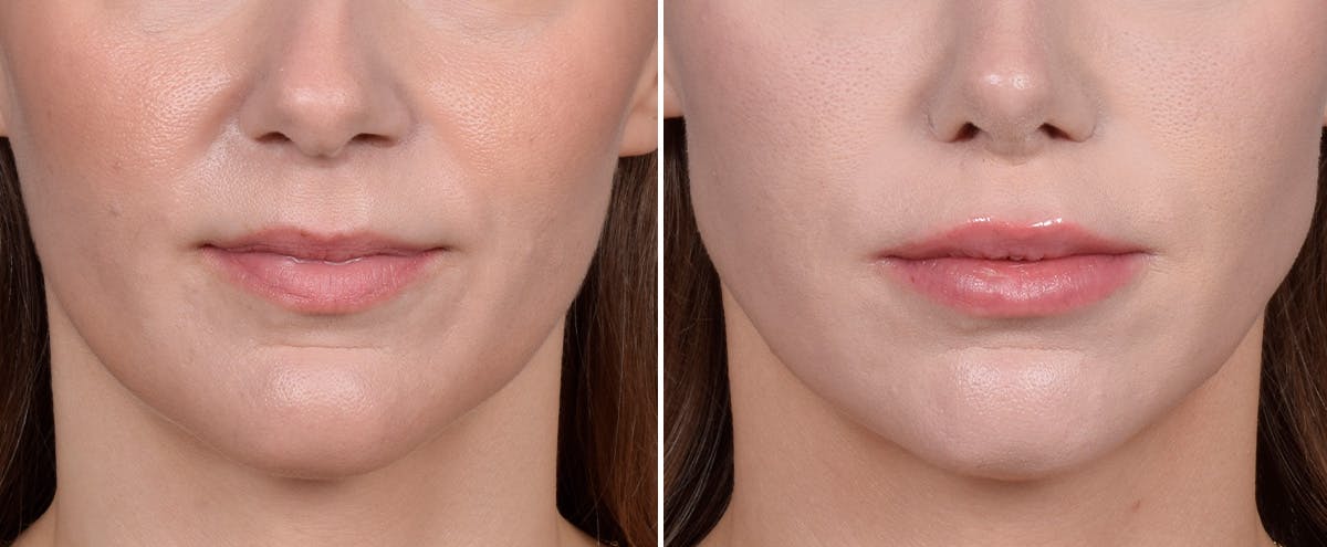 Lip Lift result at Vegas Facial Plastics