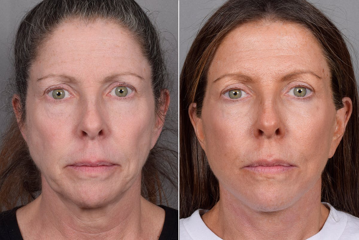 Facelift result at Vegas Facial Plastics