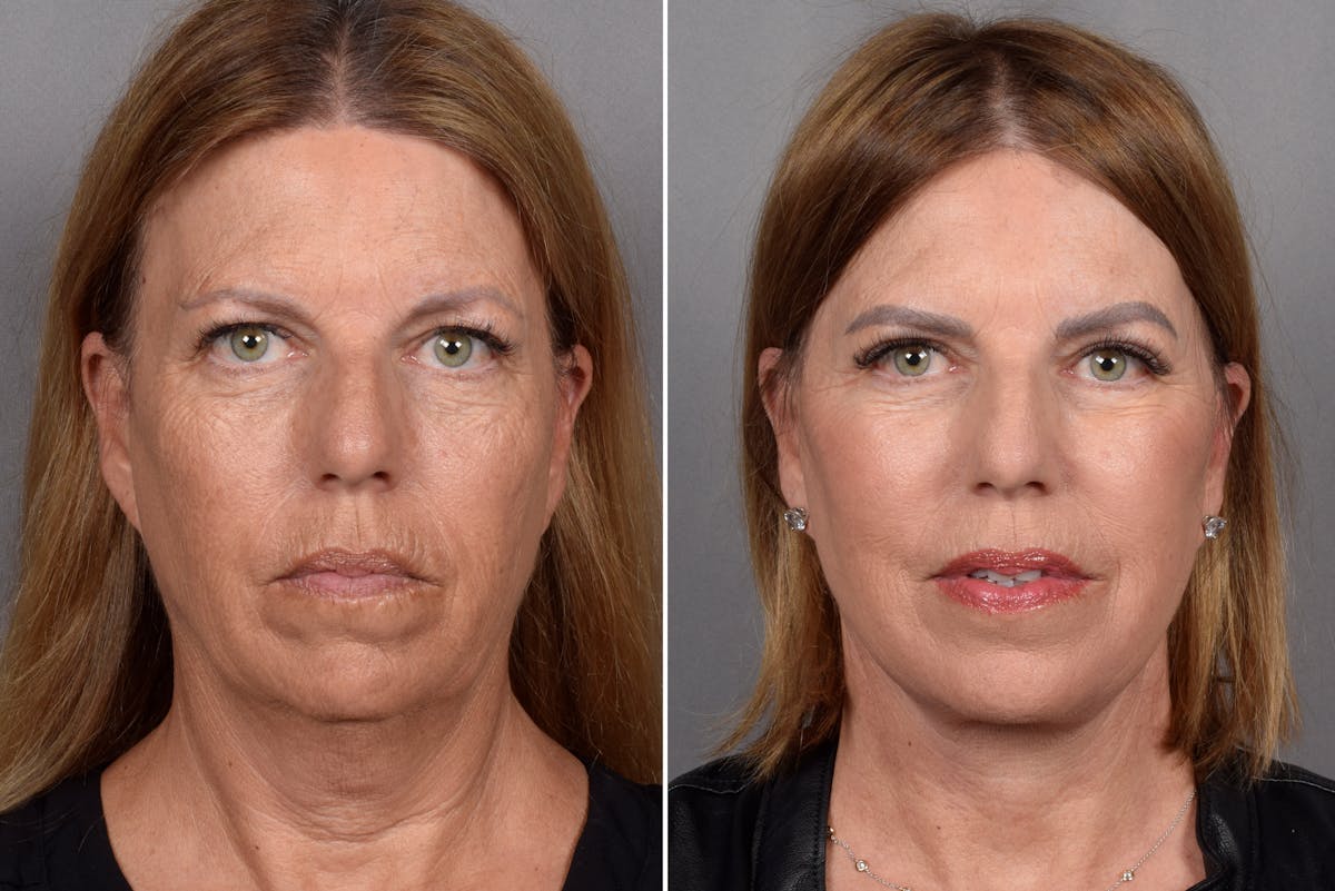 Facelift result at Vegas Facial Plastics