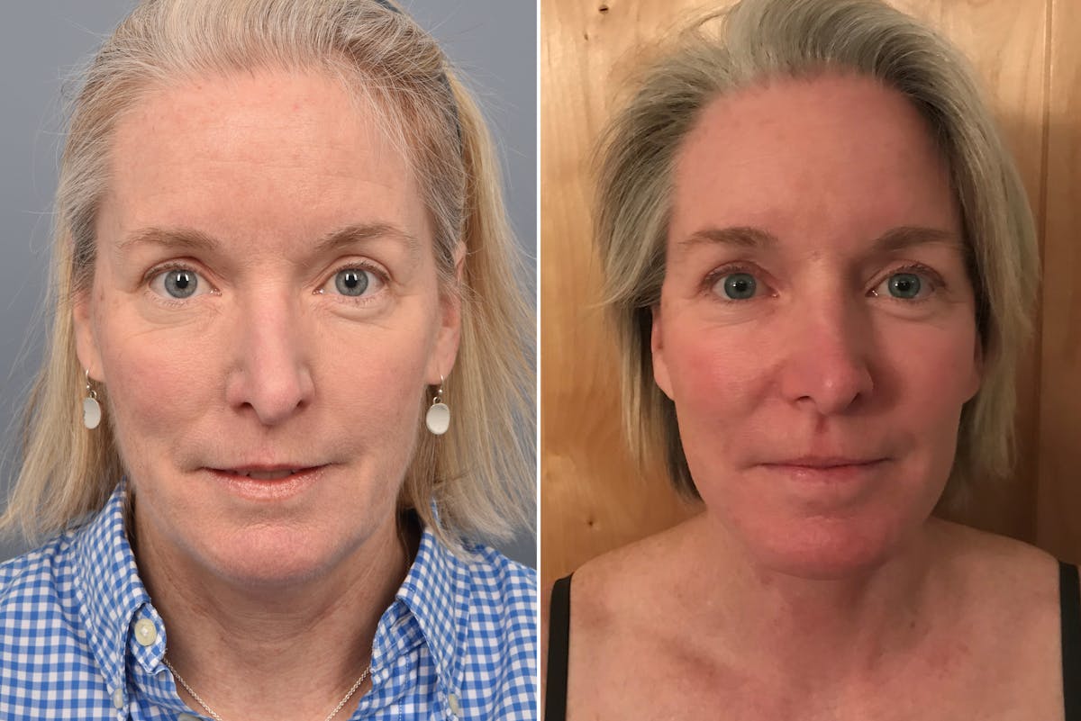 Facelift result at Vegas Facial Plastics
