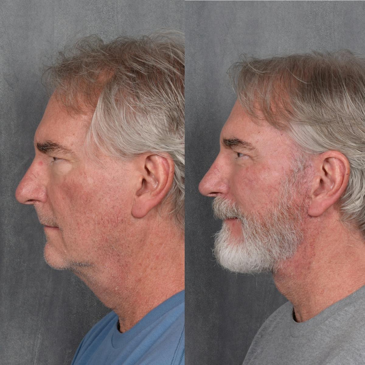 Rhinoplasty result at Vegas Facial Plastics