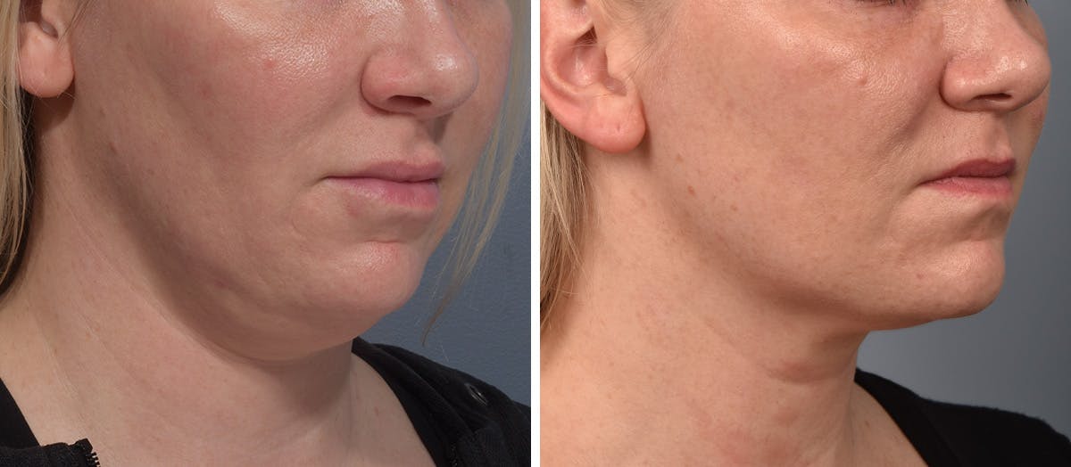 Neck Lift result at Vegas Facial Plastics
