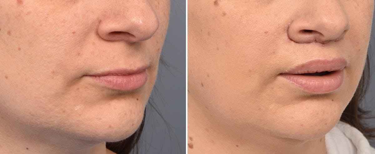 Lip Lift result at Vegas Facial Plastics