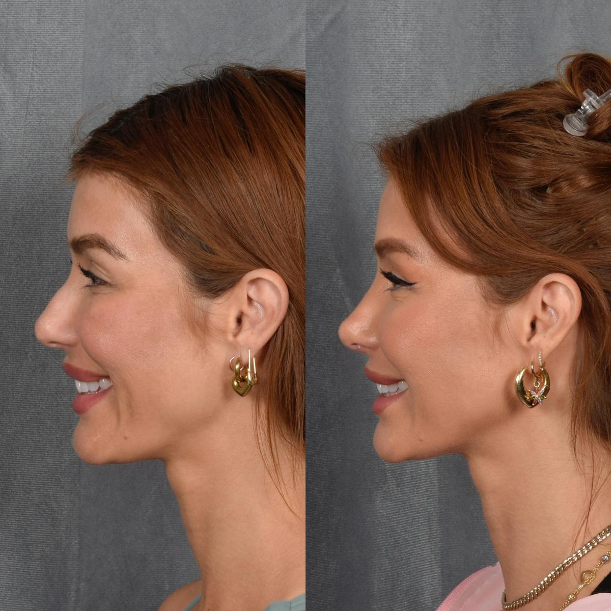 Rhinoplasty result at Vegas Facial Plastics
