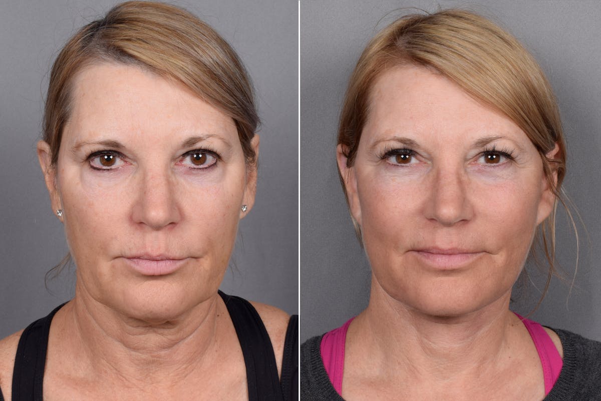 Facelift result at Vegas Facial Plastics