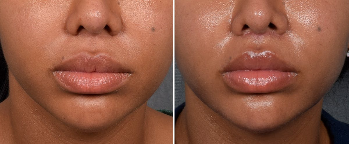 Lip Lift result at Vegas Facial Plastics