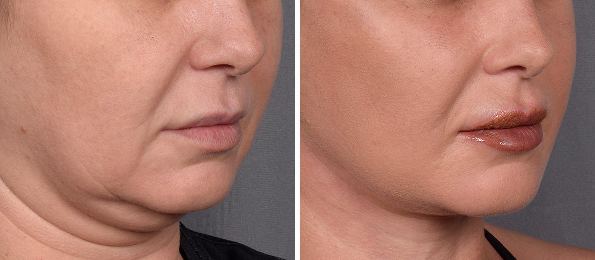 Neck Lift result at Vegas Facial Plastics
