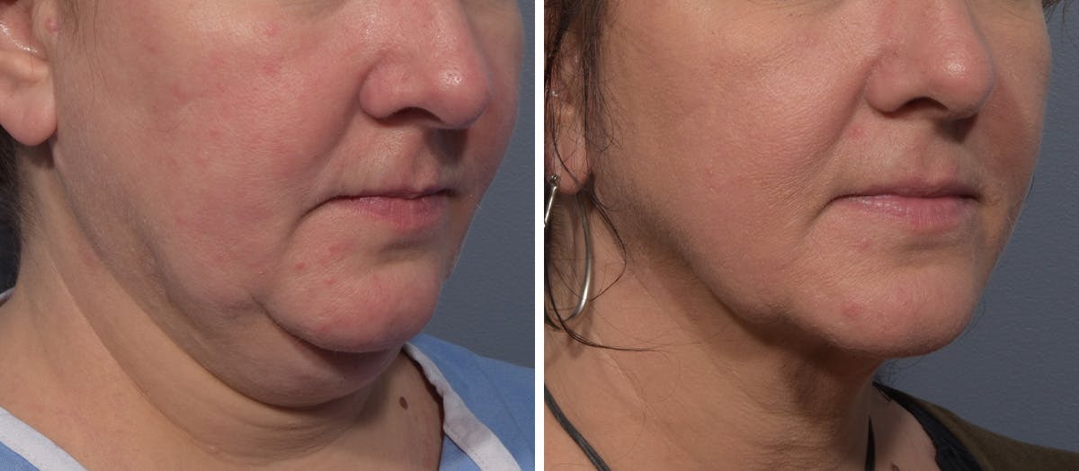 Neck Lift result at Vegas Facial Plastics