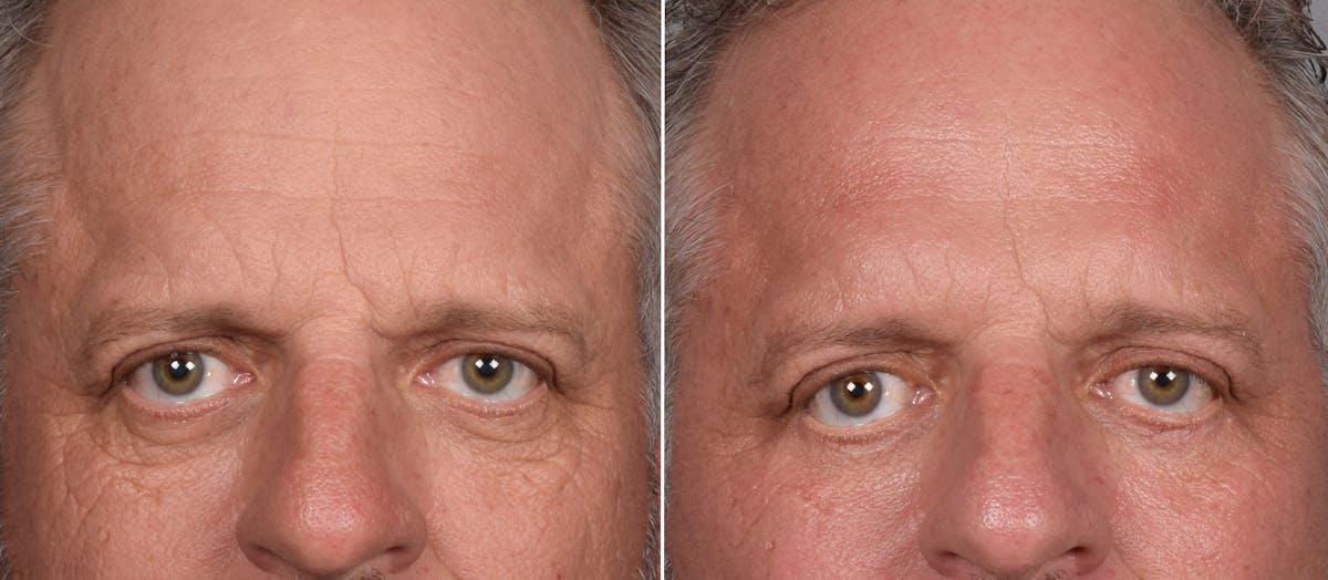 Blepharoplasty result at Vegas Facial Plastics