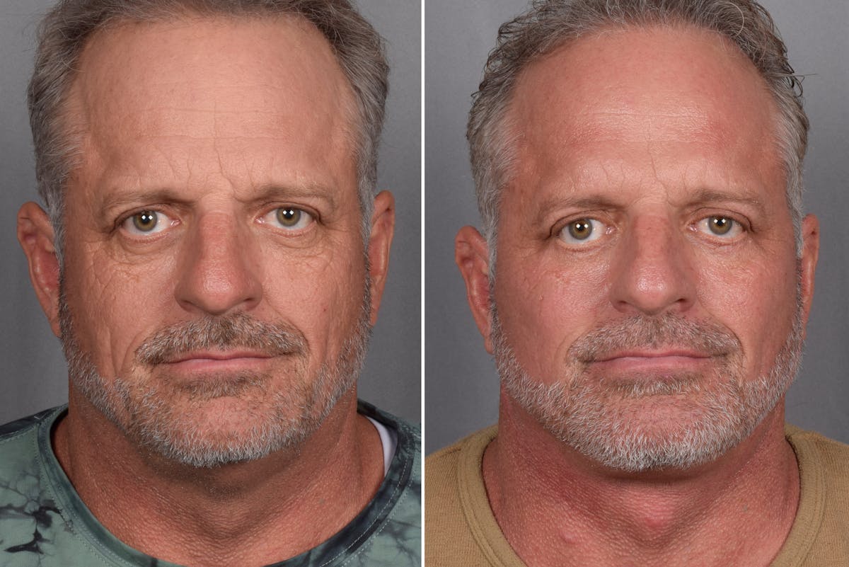 Facelift result at Vegas Facial Plastics