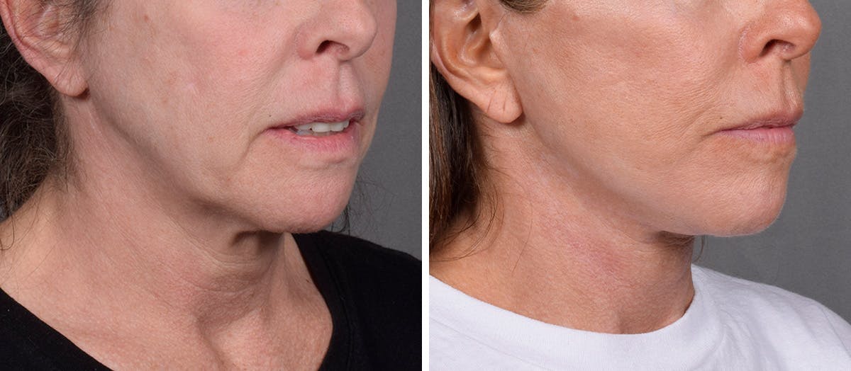 Neck Lift result at Vegas Facial Plastics