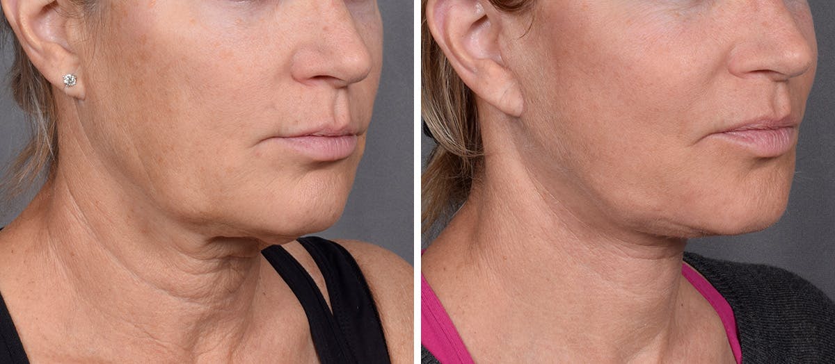 Neck Lift result at Vegas Facial Plastics