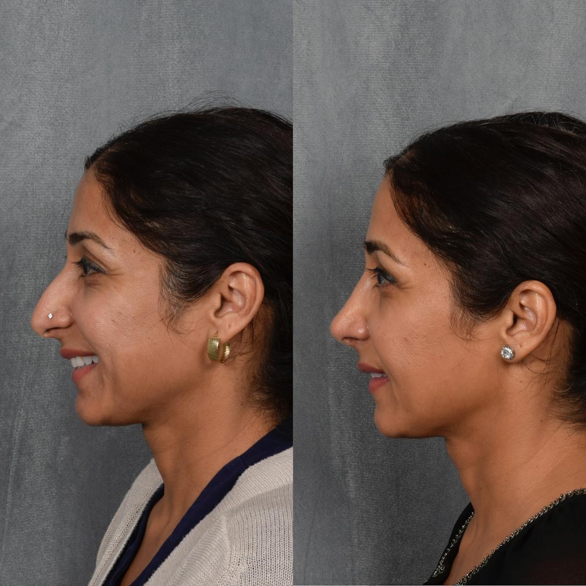 Rhinoplasty result at Vegas Facial Plastics