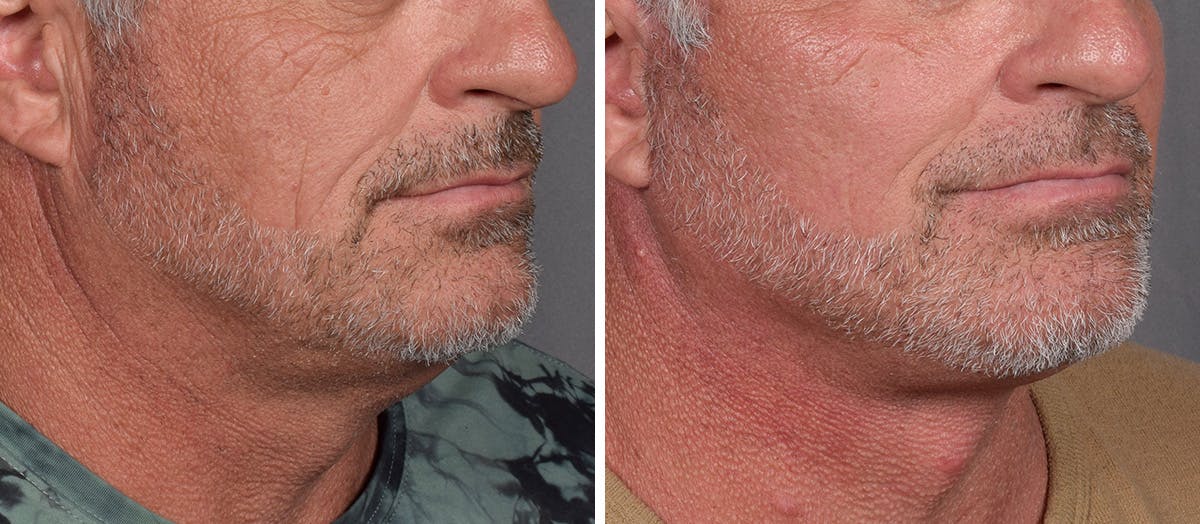 Neck Lift result at Vegas Facial Plastics