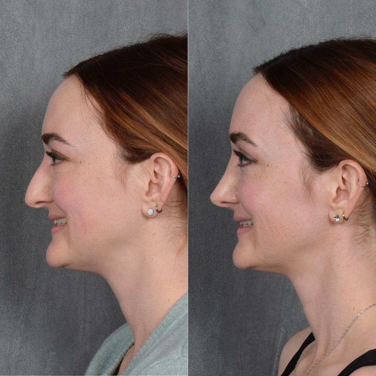 Rhinoplasty result at Vegas Facial Plastics