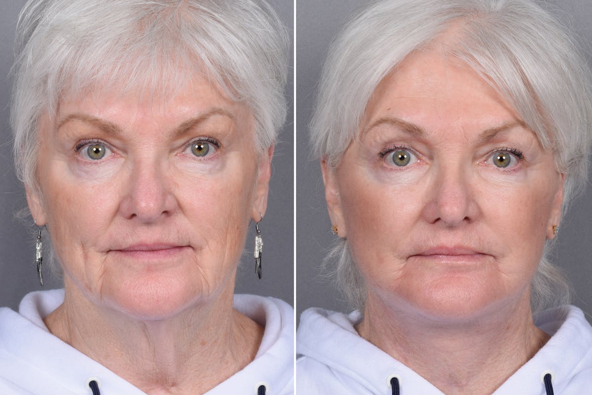 Facelift result at Vegas Facial Plastics