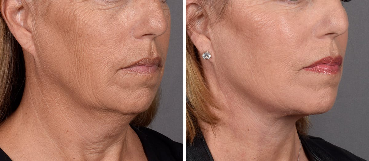 Neck Lift result at Vegas Facial Plastics