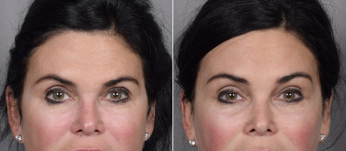 Brow Lift result at Vegas Facial Plastics