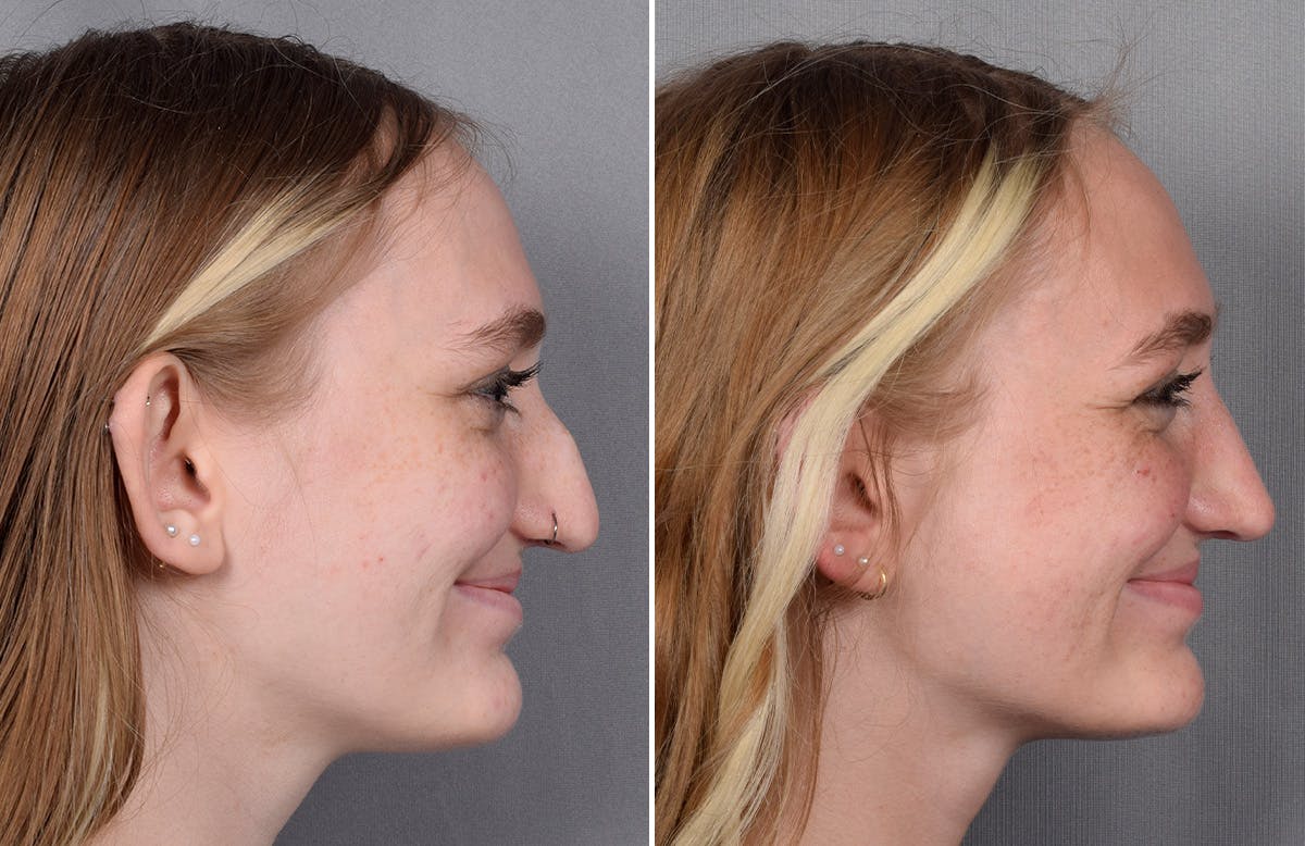 Rhinoplasty result at Vegas Facial Plastics