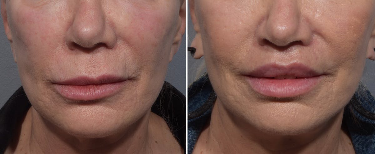 Lip Lift result at Vegas Facial Plastics