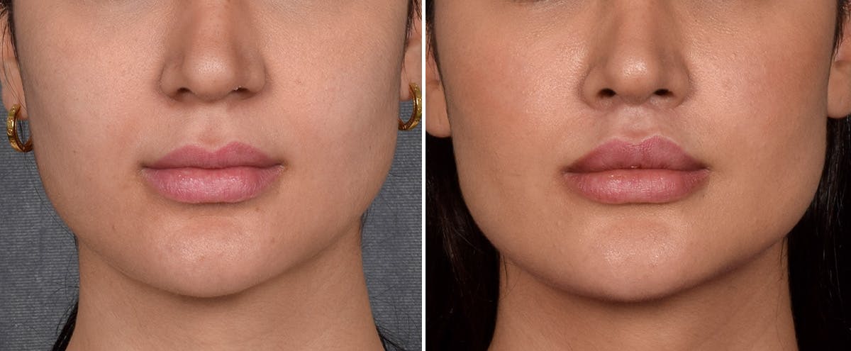 Lip Lift result at Vegas Facial Plastics