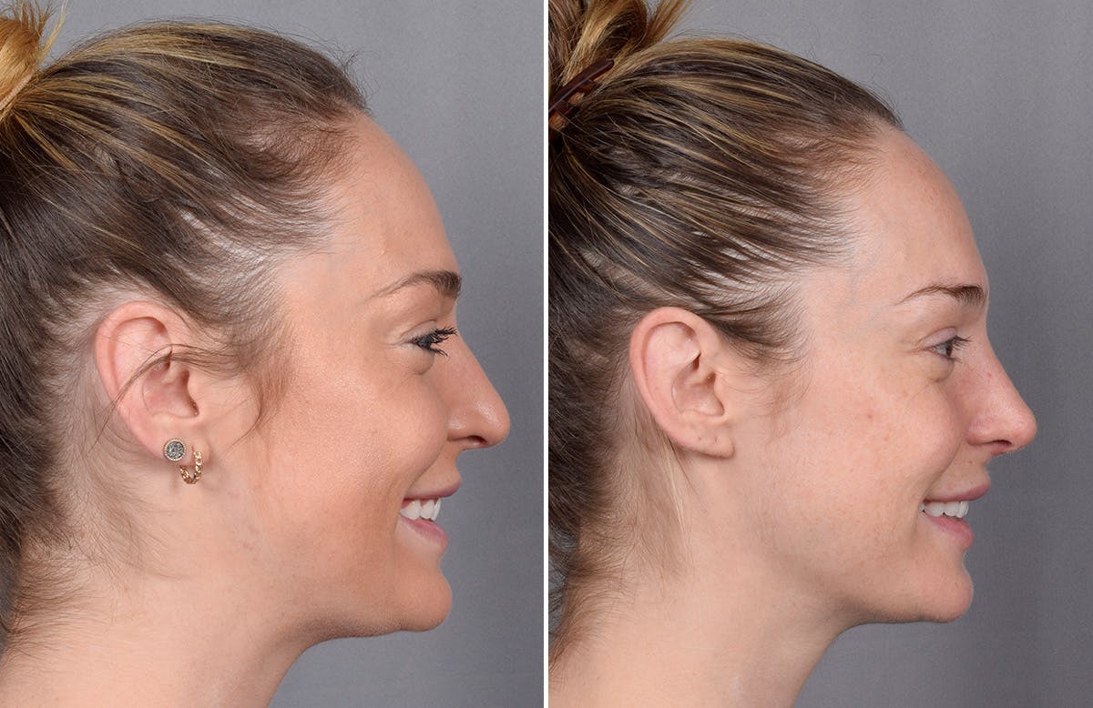 Rhinoplasty result at Vegas Facial Plastics