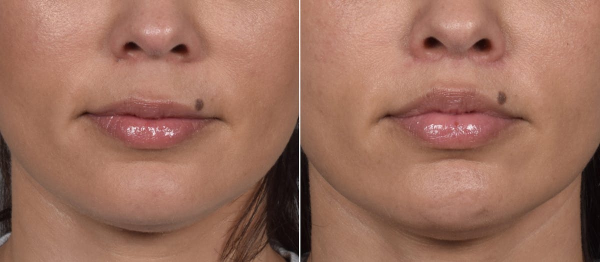 Lip Lift result at Vegas Facial Plastics