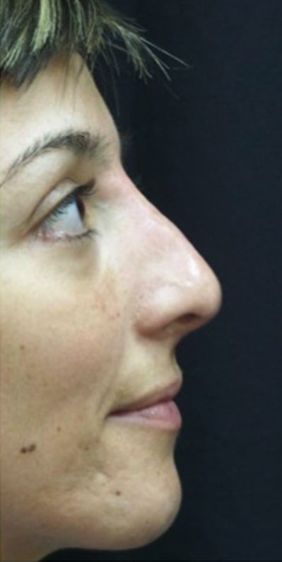 Rhinoplasty result at Beverly Hills Aesthetics