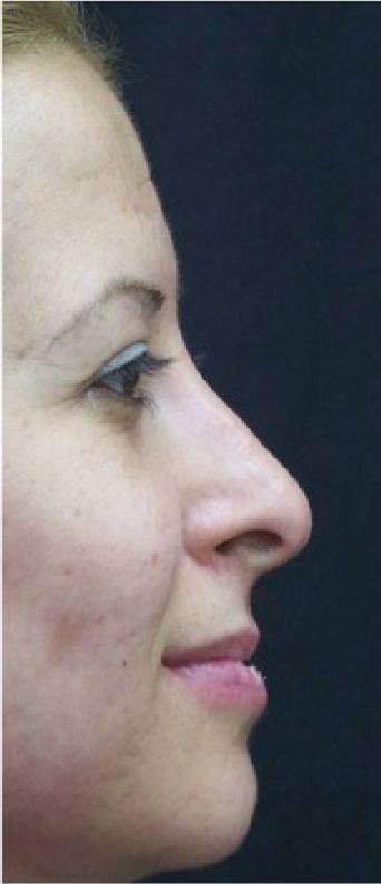 Rhinoplasty result at Beverly Hills Aesthetics